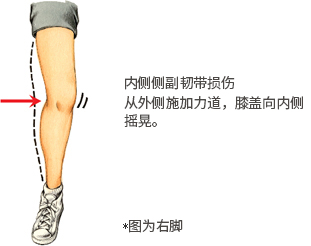 内侧侧副韧带损伤 从外侧施加力道，膝盖向内侧摇晃。 *图为右脚