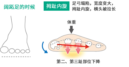 阔跖足的时候 拇趾内旋 足弓塌陷，宽度变大，拇趾内旋，横头被拉长 体重 第二、第三趾部位下降
