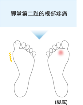 脚掌第二趾的根部疼痛 (脚底)