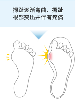 拇趾逐渐弯曲、拇趾根部突出并伴有疼痛
