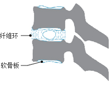 纤维环 软骨板